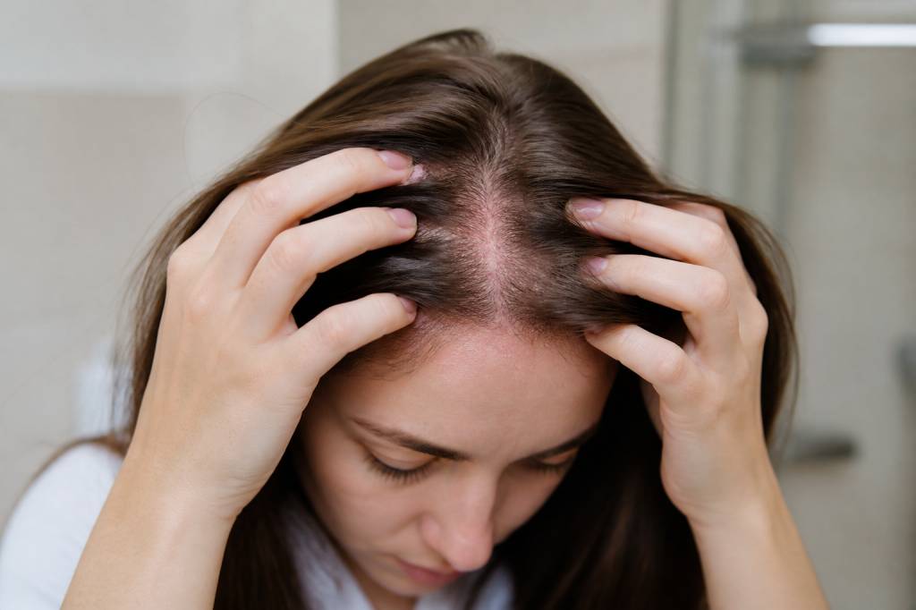 Eczéma dans les cheveux : causes, symptômes et soins naturels