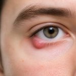 À quoi est dû un orgelet ? Causes, symptômes et remèdes naturels
