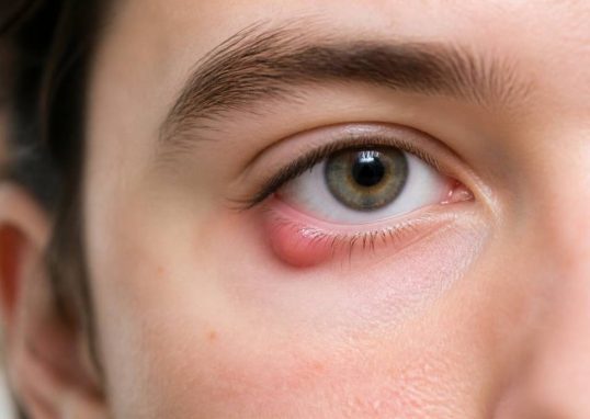 À quoi est dû un orgelet ? Causes, symptômes et remèdes naturels