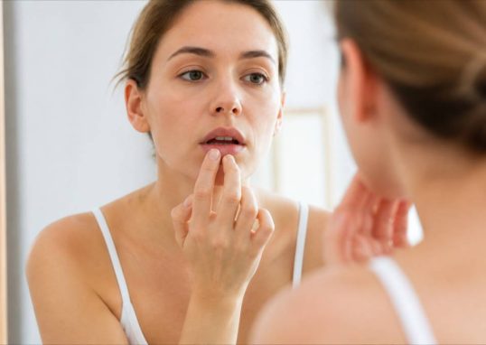 Chapped lips : causes, remèdes naturels et conseils pour les lèvres gercées