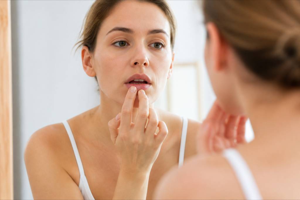 Chapped lips : causes, remèdes naturels et conseils pour les lèvres gercées