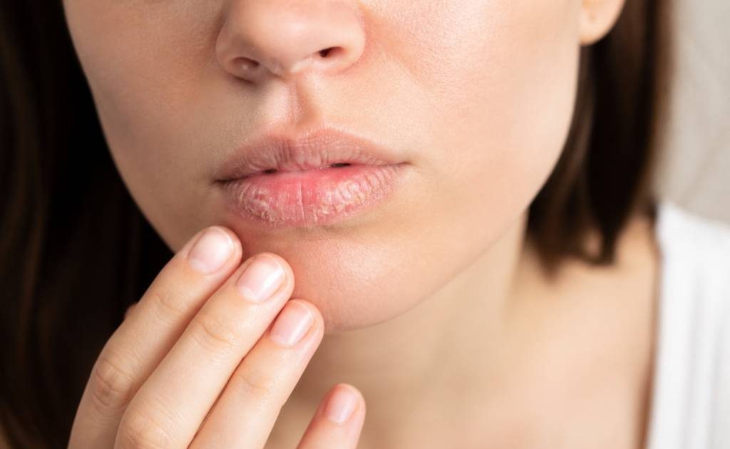 Gercure des levres : causes, soins naturels et conseils pour des lèvres réparées