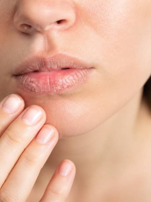 Gercure des levres : causes, soins naturels et conseils pour des lèvres réparées
