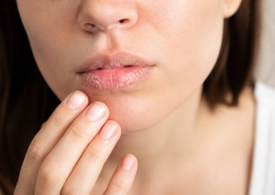 Gercure des levres : causes, soins naturels et conseils pour des lèvres réparées