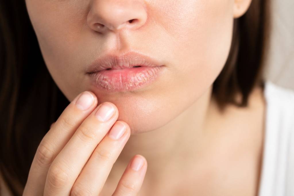 Gercure des levres : causes, soins naturels et conseils pour des lèvres réparées